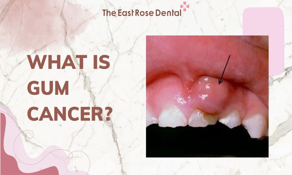 Gum Cancer Symptoms: What to Look For & When to See a Dentist